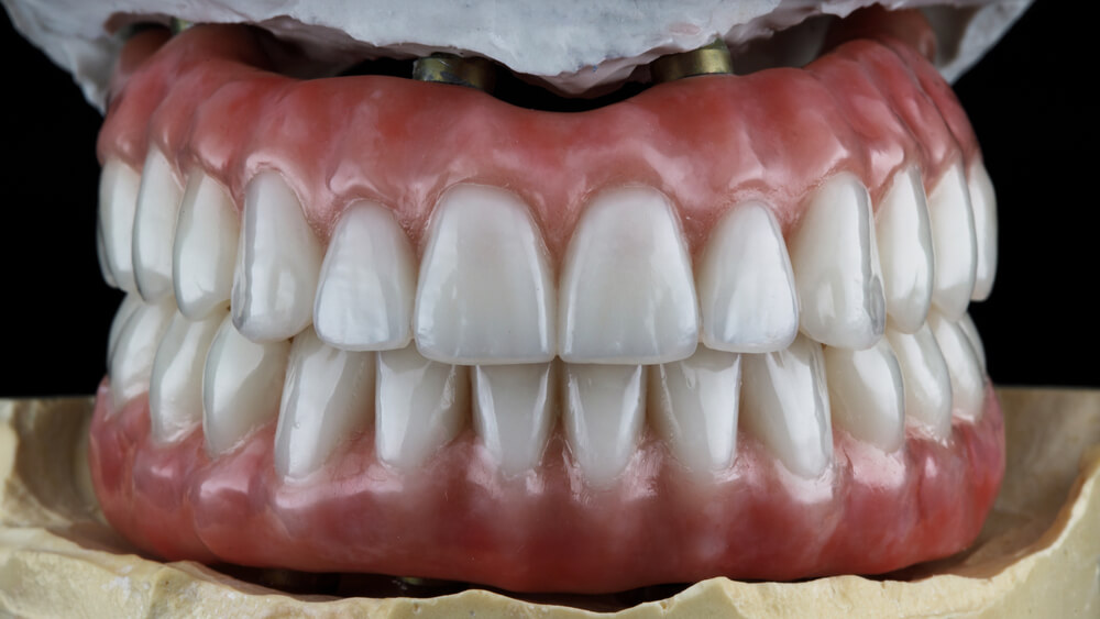 PFM- Dental implant