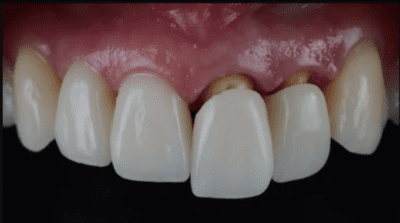 All-Ceramic Crown Tooth Preparation