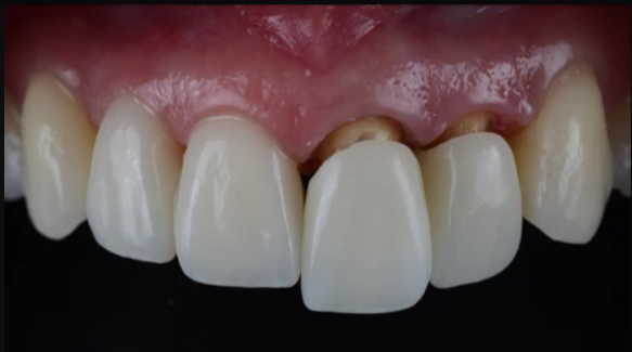 all-ceramic-crown-puche-dental-lab