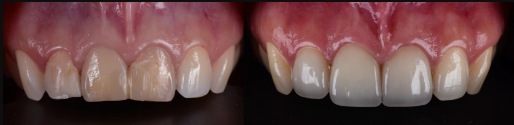 dental-all-ceramic-crown-before-after-puche-dental-labs