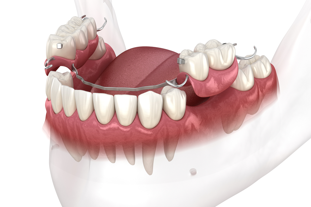 removable-partial-denture_ puche dental lab