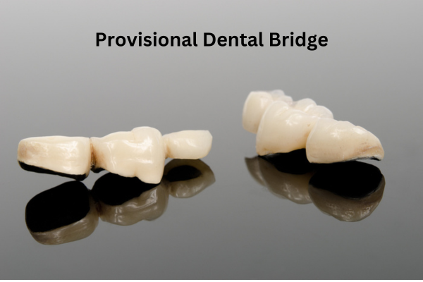 Provisional-Dental-Bridge